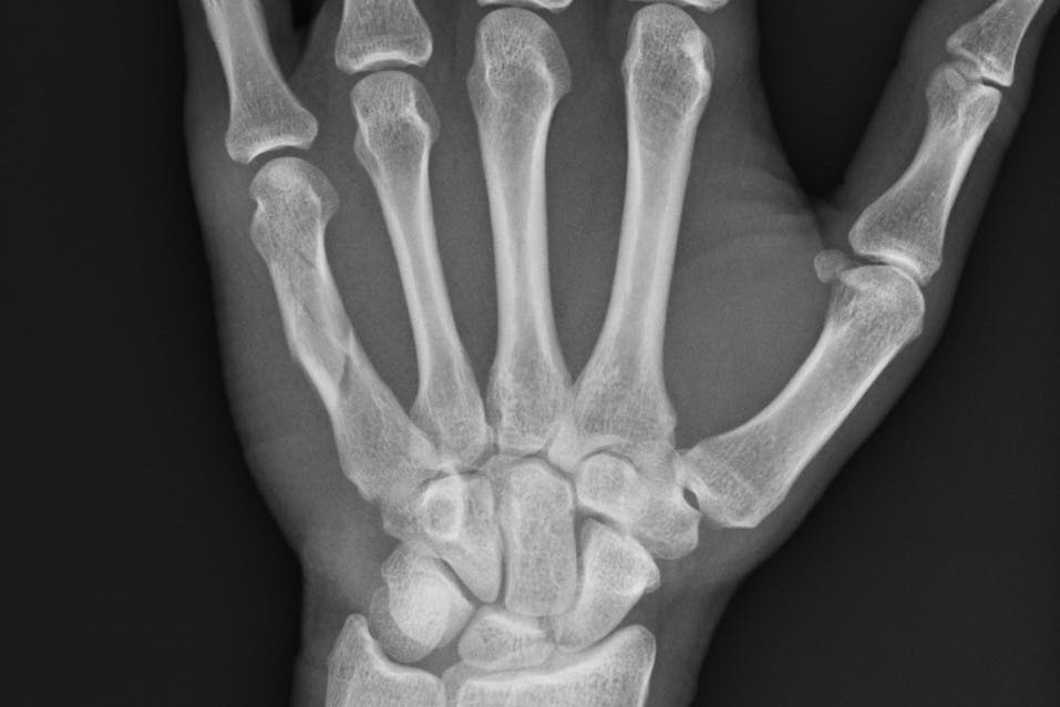 An X-ray image of a broken had. Sad face.